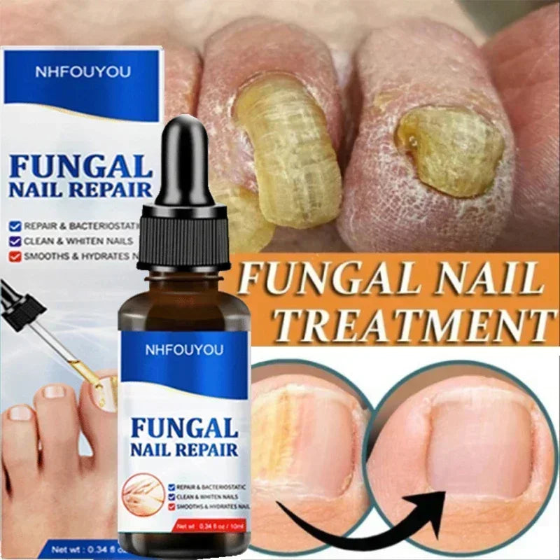 Nail Fungus Treatment Serum Toe Fungal Repair Products Hand Foot Care Removal Gel Anti Infection Paronychia Onychomycosis