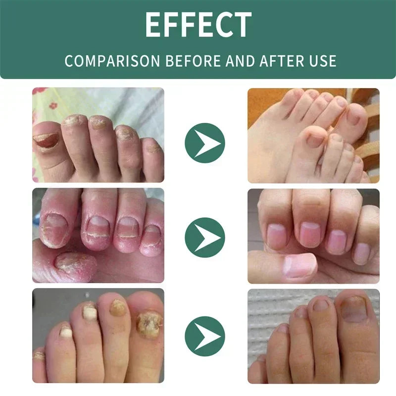 Nail Fungus Treatment Serum Toe Fungal Repair Products Hand Foot Care Removal Gel Anti Infection Paronychia Onychomycosis