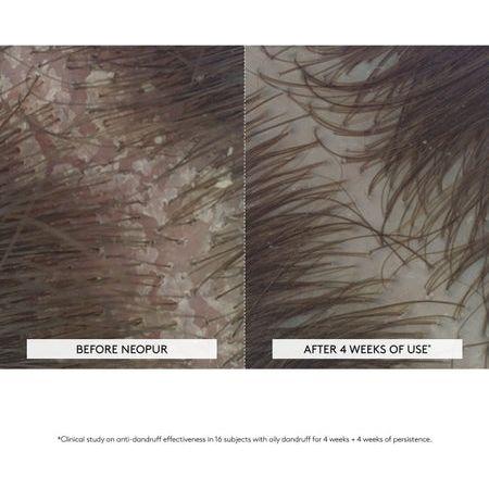 Rene Furterer Neopur Anti-Dandruff Balancing Shampoo bottle for oily, flaky scalp, 150ml, displayed on a white background.