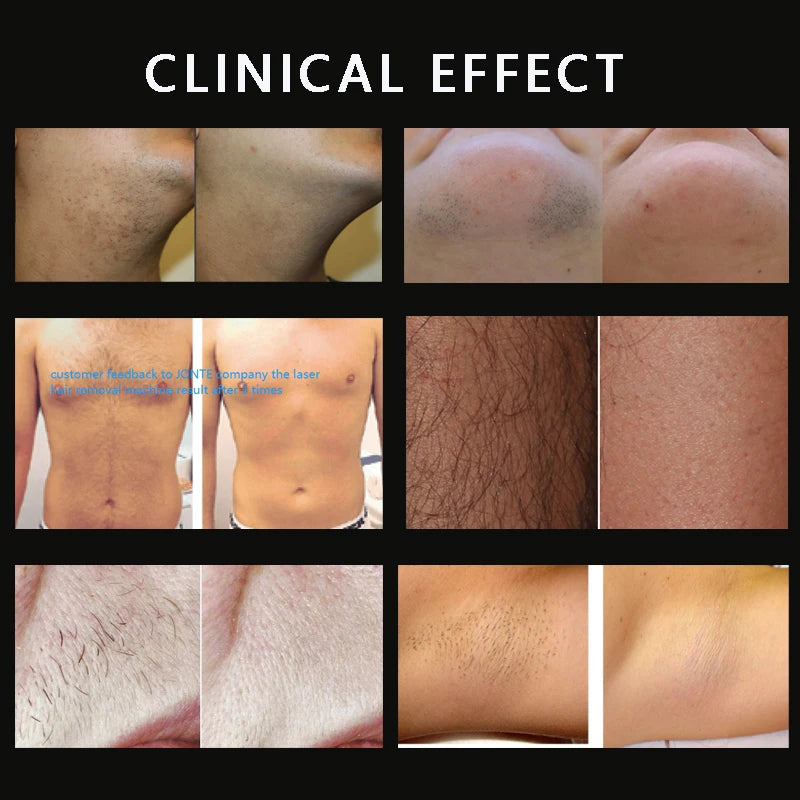 Approved MDR 808nm Diode Laser Hair Removal Machine 755nm 808nm 940NM 1064nm Spot Sizes for Body Bikini/Intimate Armpit Areas