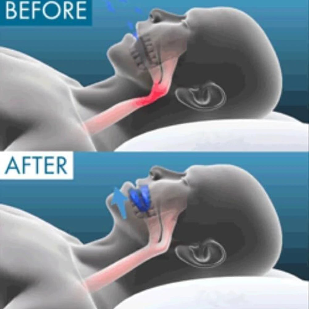 Effective Anti-Snoring Mouthpiece For Stops Snoring Mouth Guard Soft Comfortable Sleeping Aid For Improve Sleeping Quality Use