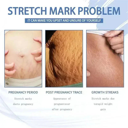 Maternity Stretch Mark Permanent Removal cream Brighten Anti-Winkle Smooth Repair Firming Restore Skin Elasticity Body Skin Care
