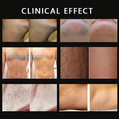 Approved MDR 808nm diode laser hair removal machine with multiple wavelength options and spot sizes for body, bikini, and armpit areas.
