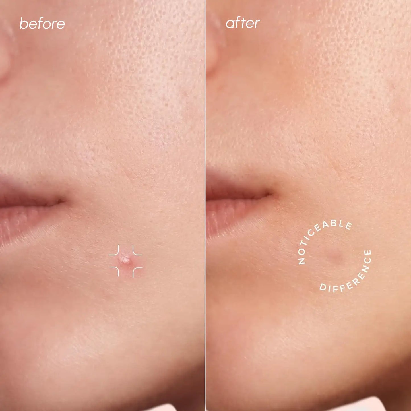 Maree Build Your Bundle Invisible Pimple and Acne Patches applied on clear skin for targeted blemish treatment.
