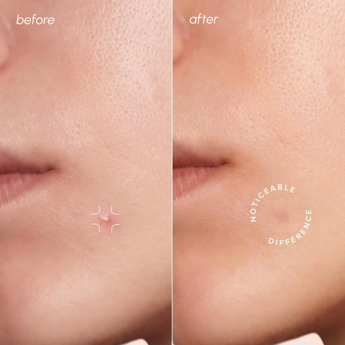 Maree Build Your Bundle Invisible Pimple and Acne Patches applied on clear skin for targeted blemish treatment.